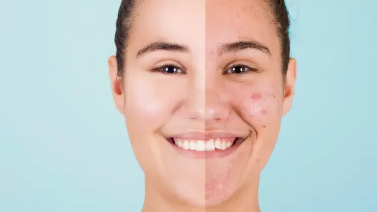 chanvre-lutter-cbd-acne
