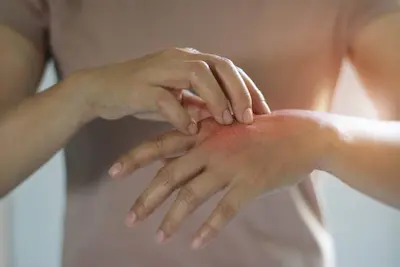 image-le-cbd-un-allie-contre-le-psoriasis-et-l-eczema