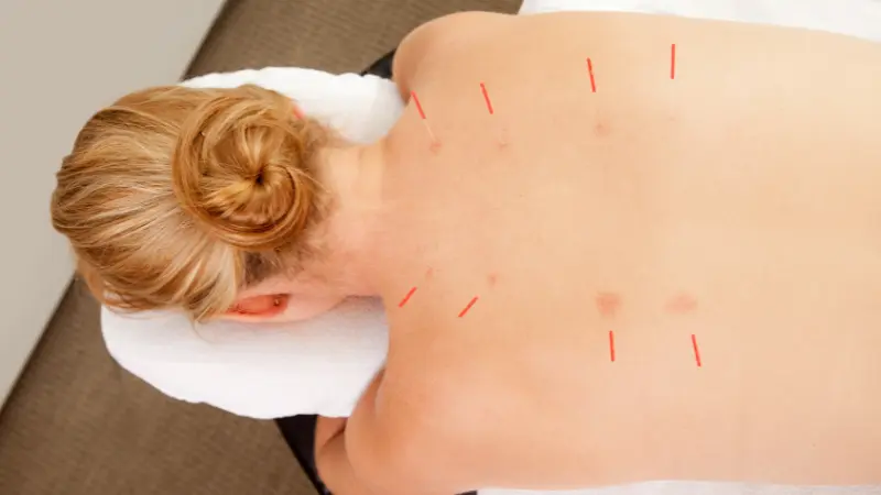 Acupuncture-Points-